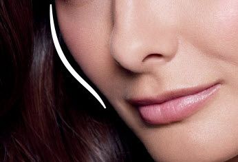 Juvederm Voluma XC for the cheeks