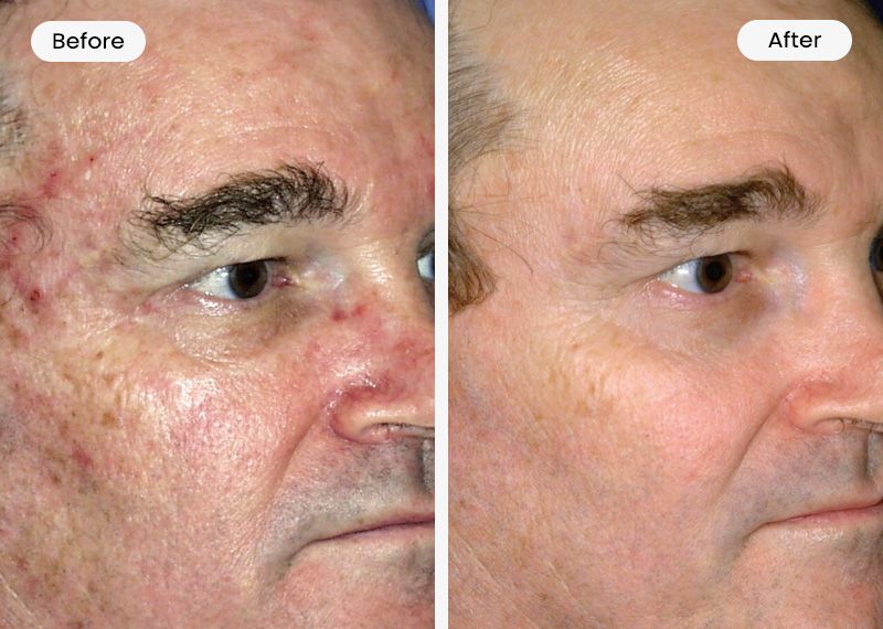 Contour TRL Before and After