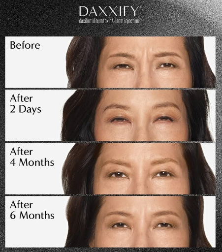 Daxxify Before and After