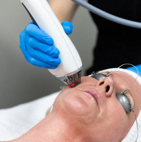 Moxi Laser Resurfacing
