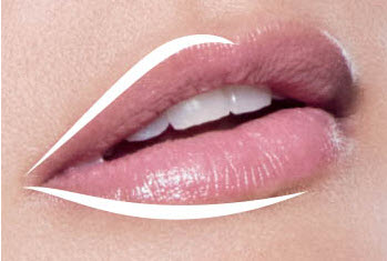 Juvederm Volbella for Lips