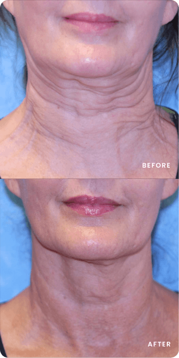 Sofwave Patient Transformations