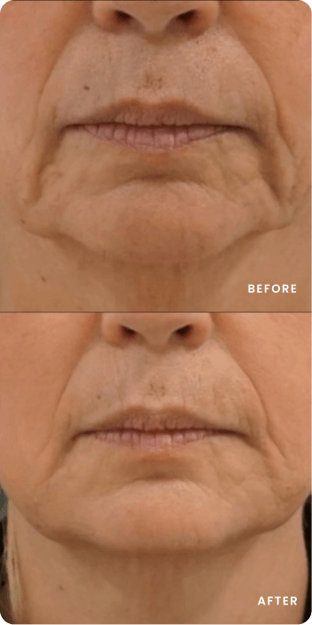 Sofwave Patient Transformations
