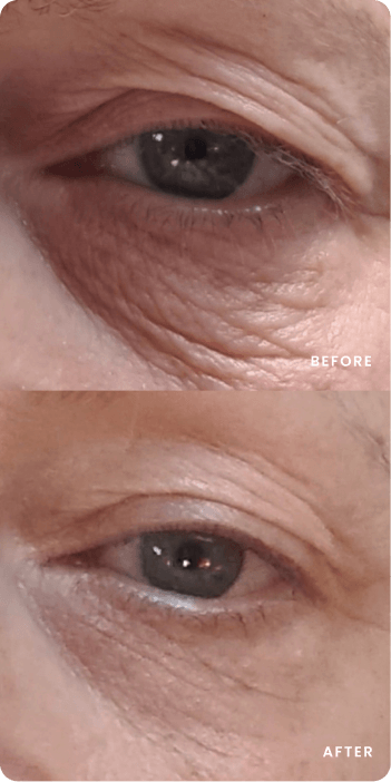 Sofwave Patient Transformations