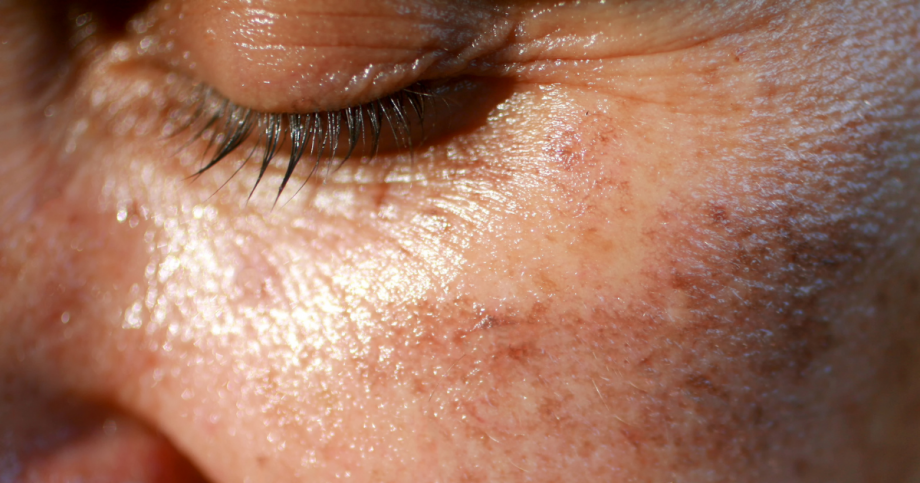 sun damaged skin