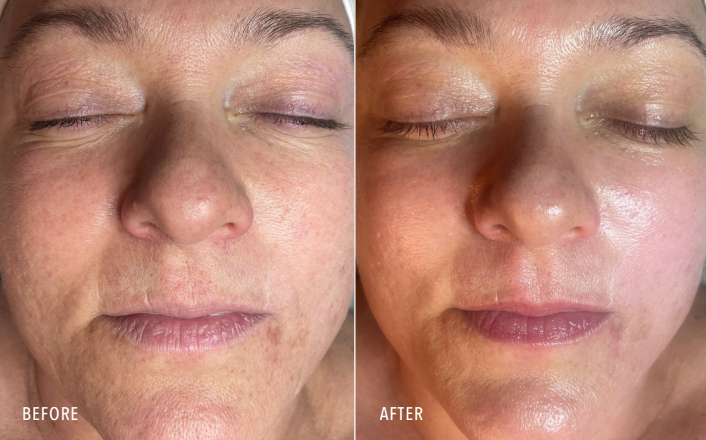 Botox in Naples Florida at our Medspa