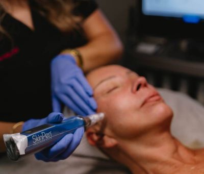 Microneedling